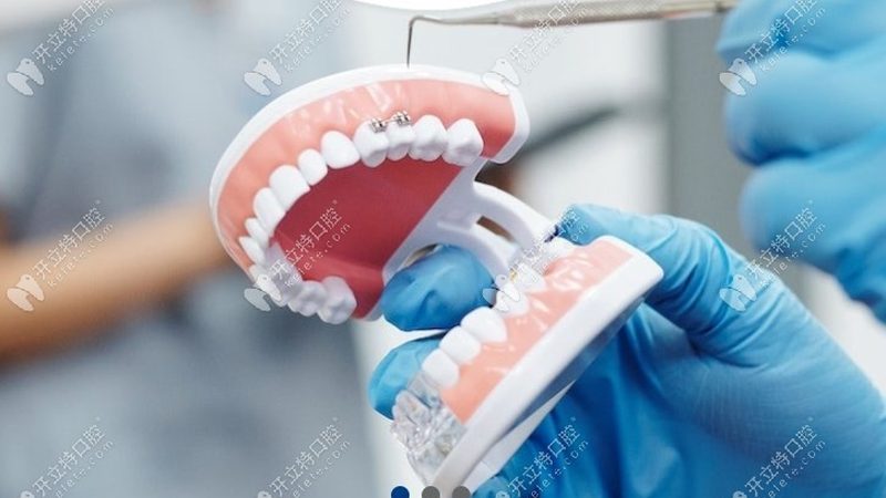 正畸橡皮筋挂法图解：掌握正确使用技巧，让你的矫正之旅更顺畅**