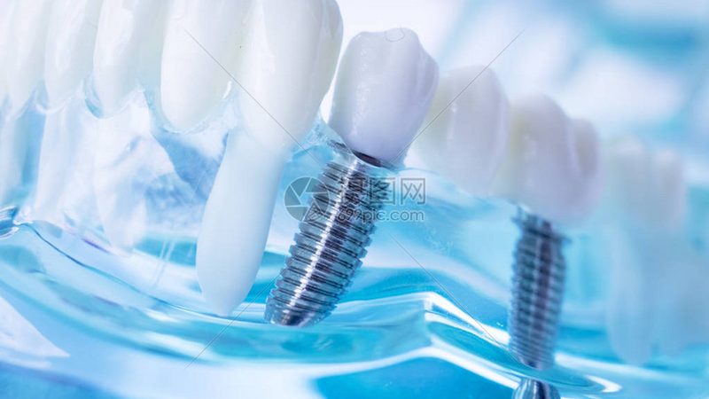 隐形牙套与钢丝牙套：使用寿命背后的技术考量